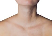 Botox no pescoço? Dra Paula Ahmed explica como funciona e quais as finalidades do procedimento